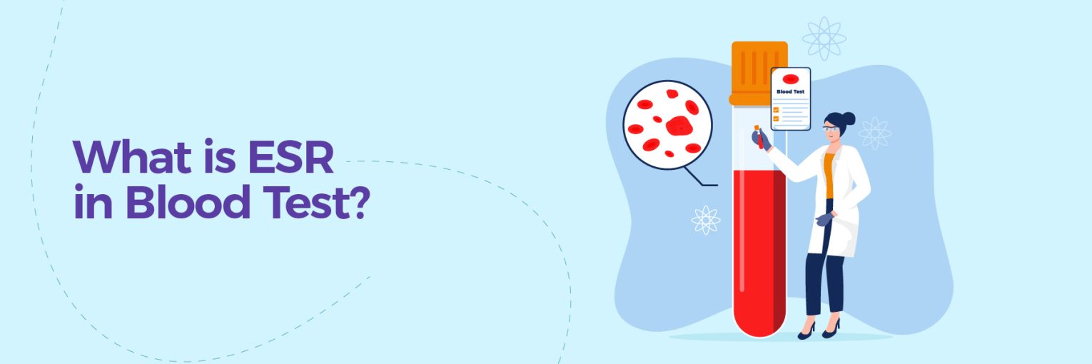 Sedimentation Rate (ESR) Test: Normal Range and Results